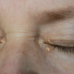 Párpados con xantelasma, depósitos amarillentos de colesterol cerca de los ojos.
