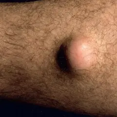 Ein gutartiger Tumor, eine helle, runde Beule, hebt sich auf der behaarten Haut eines Arms ab.