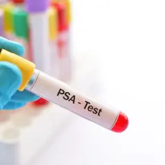 Rękawiczka trzyma probówkę z napisem "PSA - Test". To badanie pozwala sprawdzić, co to jest PSA.