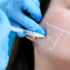 En injektion ges i käkpartiet, markerat med linjer, för masseter botox.