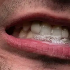 Bocca con schiuma e denti visibili. La salivazione eccessiva può essere un sintomo di ansia.