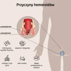 Ilustracja przedstawia przyczyny hemoroidów: ciąża, wysiłek fizyczny, zaparcia, dieta, siedzący tryb życia, seks analny, długie przebywanie w toalecie.
