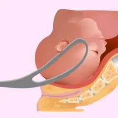 Uso di forcipe per assistere il parto, con il bambino che emerge dal bacino materno.