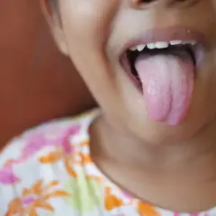 Niña saca la lengua, mostrando una capa blanca. Podría necesitar remedios caseros para la lengua blanca.