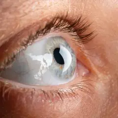 Occhio con sclera arrossata e secrezioni, suggerendo catarro agli occhi. Rimedi naturali e cure mediche possono aiutare.