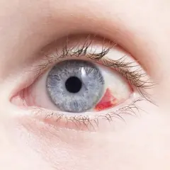 Ojo azul con hemorragia subconjuntival. Parece un bebé con ojos rojos por fuera, pero es un adulto.
