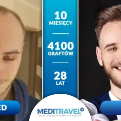 Przed i po przeszczepie włosów: 10 miesięcy, 4100 graftów, 28 lat. Zastanawiasz się, ile kosztuje przeszczep włosów?