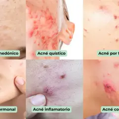 Seis tipos de granos en la cara: comedónico, quístico, por fricción, hormonal, inflamatorio y   conglobata.