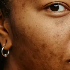 Närbild på ett ansikte med melasma. Örat med en silverring syns till vänster, och en del av ögat och munnen till höger.