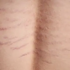 Widoczne rozstępy na plecach, świadectwo zmian w skórze, tworzą delikatny wzór na jasnej karnacji.