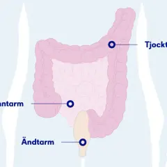 Illustration av tunntarm, tjocktarm och ändtarm. Om du upplever symtom på inflammation i tunntarmen, sök vård.