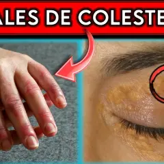 Síntomas de colesterol alto: ¿estás ignorando señales preocupantes?