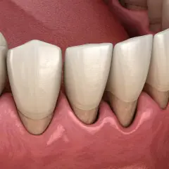 Dientes sanos y encías rosadas. Ilustración que muestra cómo tratar periodontitis para recuperar la salud bucal.