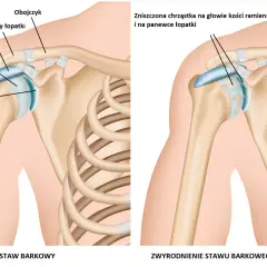 Zdrowy staw barkowy z gładką chrzątką na głowie kości ramiennej i panewce łopatki obok stawu ze zniszczoną chrząstką.