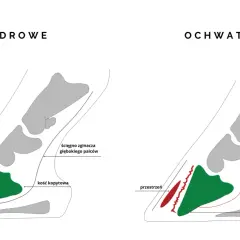Zdrowe kopyto vs. ochwatowe: rotacja kości kopytowej i naciągnięte ścięgno przy zapaleniu kopyta konia.