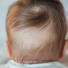 Dettaglio della nuca di un neonato con capelli castani e una chiazza di piebaldismo, dove i capelli sono più chiari.