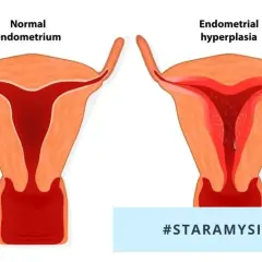 Porównanie prawidłowego endometrium z przerostem. Przerost endometrium może wymagać leczenia.