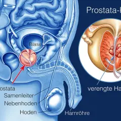 Anatomie der männlichen Beckenorgane mit Fokus auf Prostatakrebs. Ein vergrößerter Ausschnitt zeigt Tumore in der Prostata, die die Harnröhre verengen. Mögliche Prostatakrebs-Metastasen sind angedeutet.