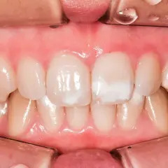 Denti con macchie bianche, possibili segni di carie iniziale.