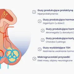 Ilustracja przedstawia przysadkę mózgową i różne guzy, które mogą wpływać na jej funkcjonowanie, powodując objawy takie jak gigantyzm czy akromegalia.