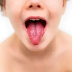 Dziecko z malinowym językiem, objawem szkarlatyny. Szybkie leczenie jest kluczowe.