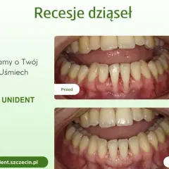 Przed i po leczeniu recesji dziąseł. Widoczne poprawa stanu dziąseł po zabiegu.