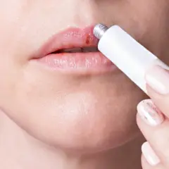 Persona aplica crema en un labio con un afta labial.