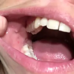 Dettaglio della bocca con afte sulla guancia interna. Si notano piccole lesioni rosse e gonfiore.