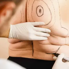 Ile kg po liposukcji? Zobacz, ile litrów tłuszczu możesz stracić