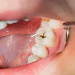 Vista de cerca de una boca con un diente que muestra caries debajo de la encía.