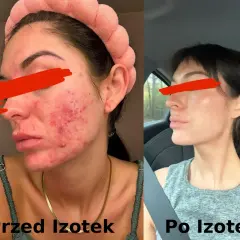 Przed i po leczeniu izotekiem: skóra z trądzikiem i zaczerwienieniem przechodzi transformację w gładką i czystą cerę.