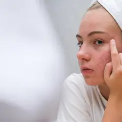 Dziewczyna z ręcznikiem na głowie dotyka palcem policzka z niedoskonałościami.