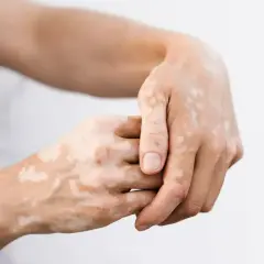 Dłonie z widocznymi plamami bielactwa (vitiligo), tworzącymi unikalny wzór na skórze.