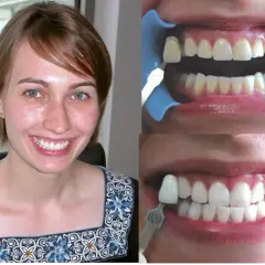 Wybielanie zębów u dentysty: Czy warto? Opinie, koszty, efekty