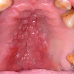 Dettaglio dell'interno bocca con palato arrossato e noduli, circondato da denti.