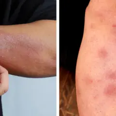 Zaburzona flora jelit: objawy, które zaskakują. Kiedy do lekarza?