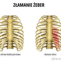 Porównanie zdrowej klatki piersiowej z tą, gdzie widoczne są stłuczone żebra bez siniaka, zaznaczone czerwonym rumieńcem.