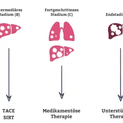 Illustration zeigt Stadien von Leberkrebs (B, C, D) mit Lungenmetastasen. Leberkrebs blutwerte sind wichtig für die Therapieentscheidung.