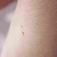 Dwa małe, brązowe włókniaki na jasnej skórze.