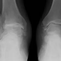 Radiografie delle caviglie mostrano segni di condropatia, con alterazioni articolari evidenti.