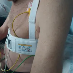 Pacjent z kardiowerterem-defibrylatorem wszczepionym pod skórę, z widocznymi elektrodami i przewodami.