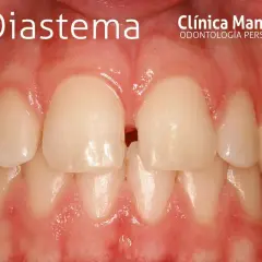 Primeros planos de dientes con un espacio visible entre los incisivos centrales superiores, un ejemplo de brackets dientes separados.