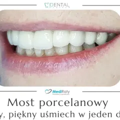 Mostek na zębach: Zobacz, jak wygląda i odzyskaj uśmiech!