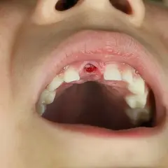 Boca de niño con un hueco donde antes había un diente, como si fuera un sueño que se te cae una muela.