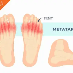 Illustrazione anatomica che mostra la metatarsalgia, un'area di dolore ai metatarsi delle dita dei piedi, evidenziata in rosso.