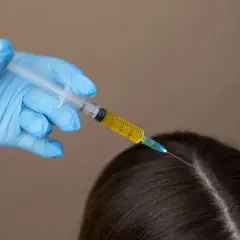 Manos enguantadas aplican inyección de ácido hialurónico en el cuero cabelludo para el cuidado del pelo.