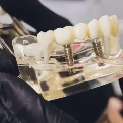 Modello di protesi dentale che illustra l'impianto dentale all on four, con viti che simulano gli impianti.
