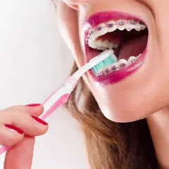 Mujer cepillando sus brackets transparentes con un cepillo rosa y blanco.