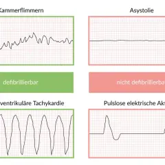 EKG-Kurven: Kammerflimmern & pulslose ventrikuläre Tachykardie (defibrillierbar) vs. Asystolie & pulslose elektrische Aktivität (nicht defibrillierbar). Wichtig für Lebenserwartung nach Reanimation.