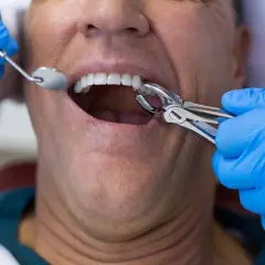 Dentista realiza extracción de muela infectada a paciente.
